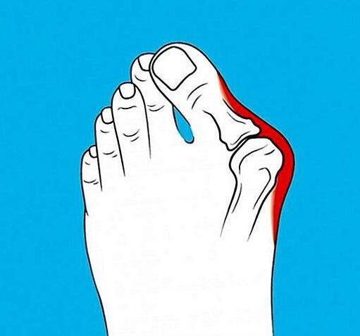 Osteoarthritis of the joint on the toe