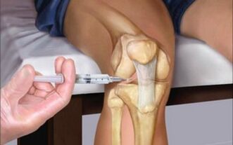intra-articular injection into the joint in osteoarthritis