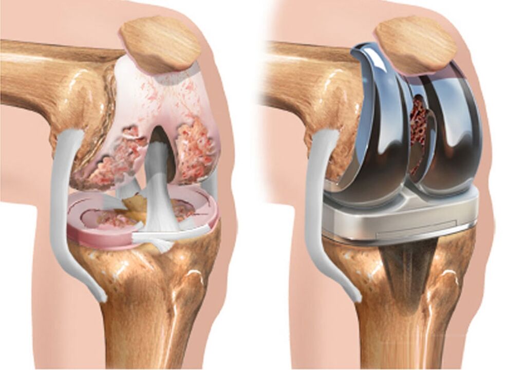 before and after osteoarthritis of the knee joint in osteoarthritis