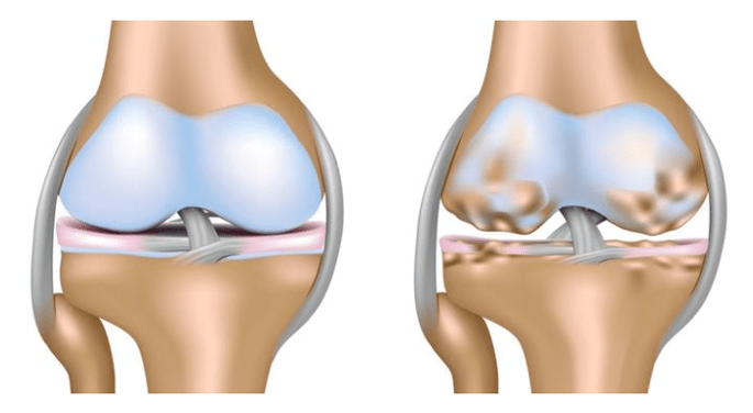 healthy cartilage and damage to the knee joint in osteoarthritis