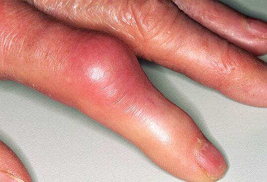 Gout is accompanied by severe pain in the fingers and swelling of the joints. 