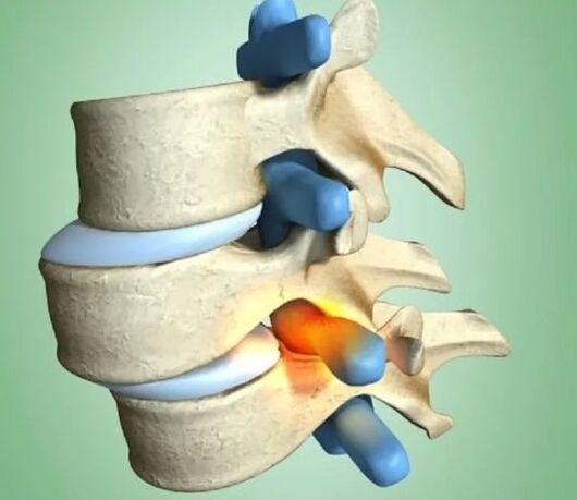 The unstable position of the vertebrae
