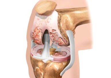 Damage to knee cararthrosis