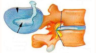 Features of the development of the cervix osteochondrosis