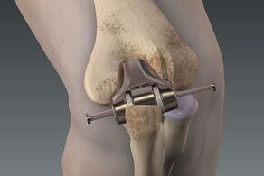 Knee replacement for osteoarthritis