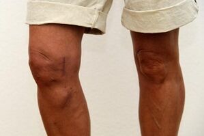 Swelling of the knee joint due to osteoarthritis