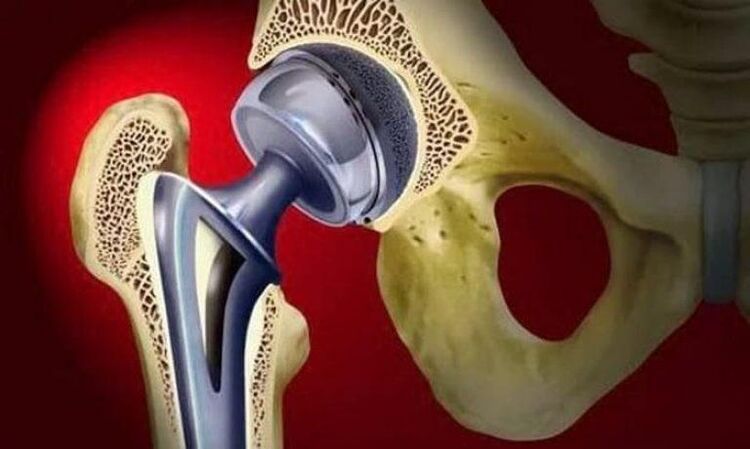 Endoprosthetics